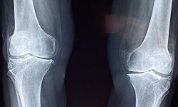 Специалисты представили уникальный материал для костных имплантатов