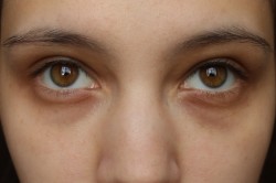 Темные круги под глазами могут говорить о прогрессирующей гипоксии