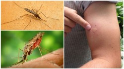 Как распознать, что черви свили гнездо в вашем теле после укуса комара