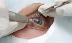 Методы лечения катаракты глаз