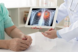 Медик назвал единственный способ вовремя выявить злокачественную опухоль в лёгких